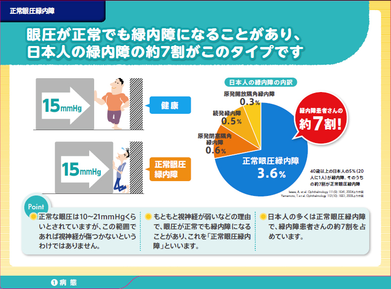 眼圧が正常でも緑内障になることがあり、日本人の緑内障の約7割がこのタイプです