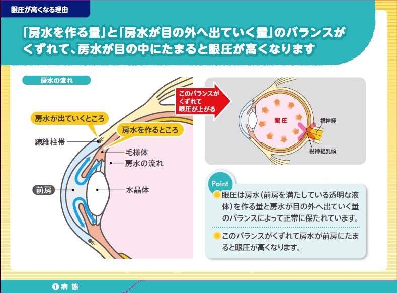 「房水を作る量」と「房水が目の外へ出て行く量」のバランスがくずれて、房水が目の中にたまると眼圧が高くなります