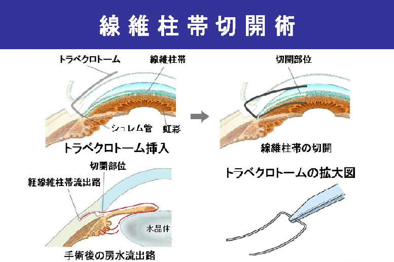 線維柱帯切開術