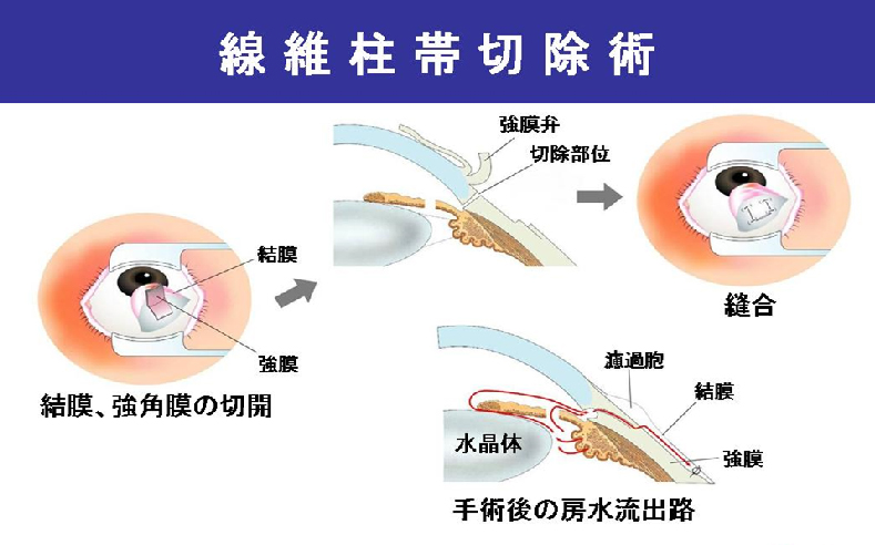 線維柱帯切除術