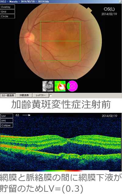 加齢黄斑変性症注射前