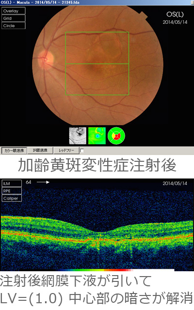 加齢黄斑変性症注射後