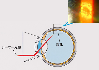 網膜光凝固（レーザー）