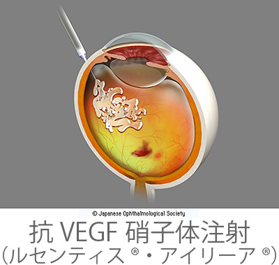 抗VEGF療法（ルセンテイス®、アイリーア®）