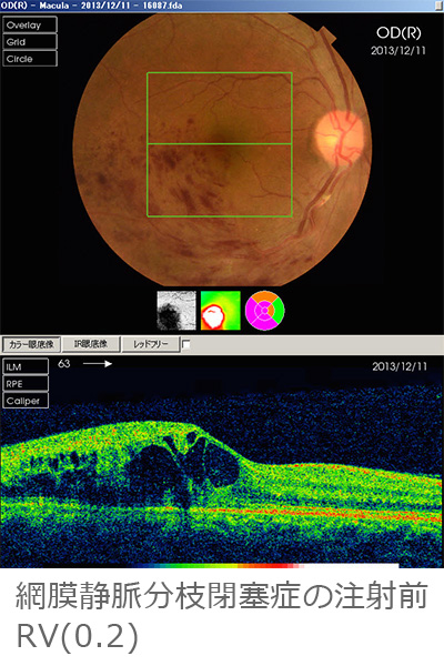 網膜静脈分枝閉塞症の注射前RV(0.2)