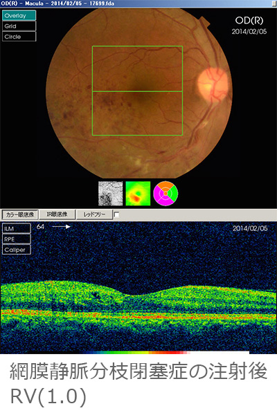 網膜静脈分枝閉塞症の注射後RV(1.0)